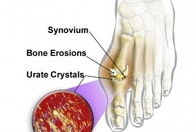 Cách phòng và điều trị bệnh Gout hiệu quả