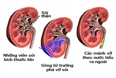 “8 nguyên tác vàng” đề phòng và bảo vệ thận