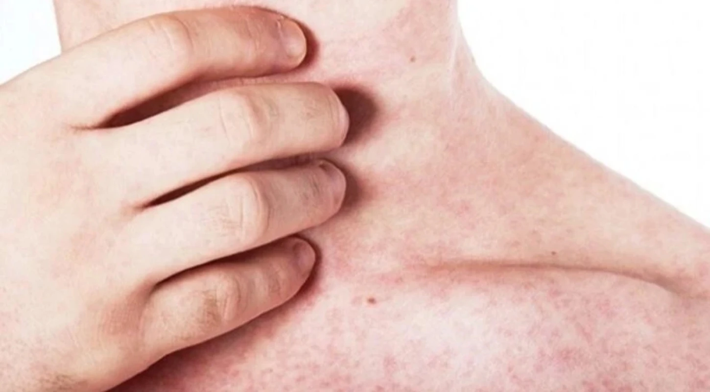 Bệnh sởi là gì? Dấu hiệu nhận biết bệnh sởi