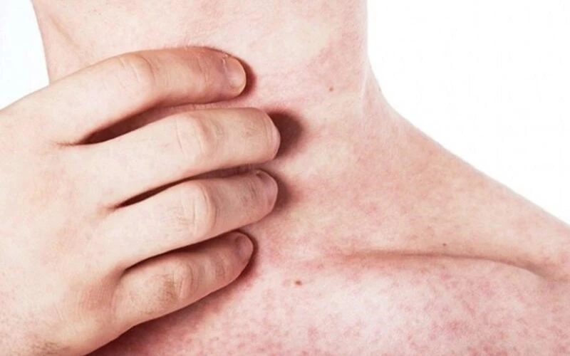 Bệnh Sởi: Nguyên Nhân, Dấu Hiệu, Biến Chứng và Cách Phòng Ngừa Hiệu Quả